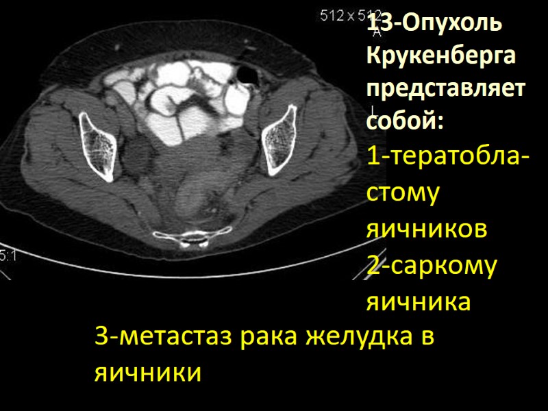 13-Опухоль Крукенберга представляет собой: 1-тератобла-стому яичников  2-саркому яичника 3-метастаз рака желудка в яичники